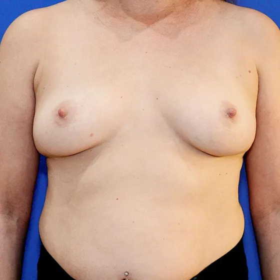 Brustvergrößerung, 44 Vorher-Nachher