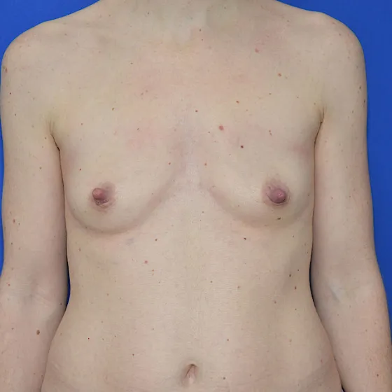 Bruststraffung mit Implantat, 39 Vorher-Nachher