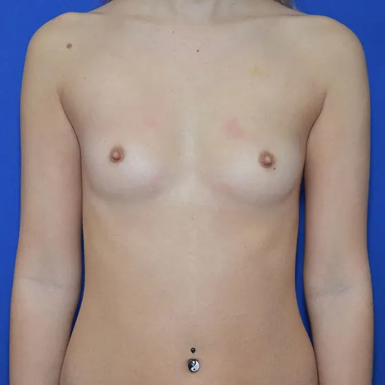 Brustvergrößerung, 23 Vorher-Nachher