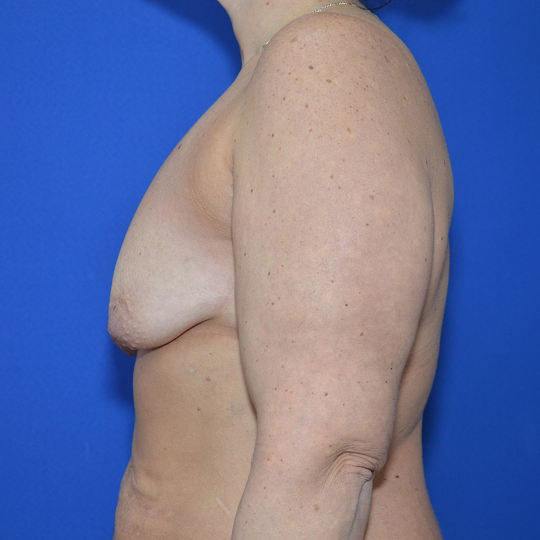 Bruststraffung mit Implantat Vorher (3)