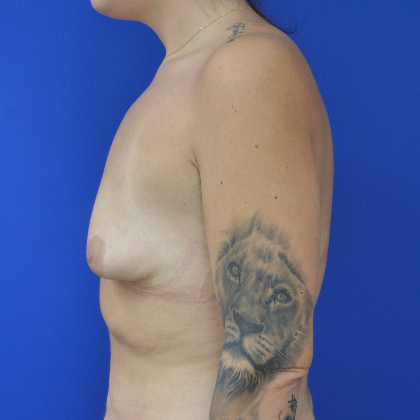 Bruststraffung mit Implantat Vorher (2)