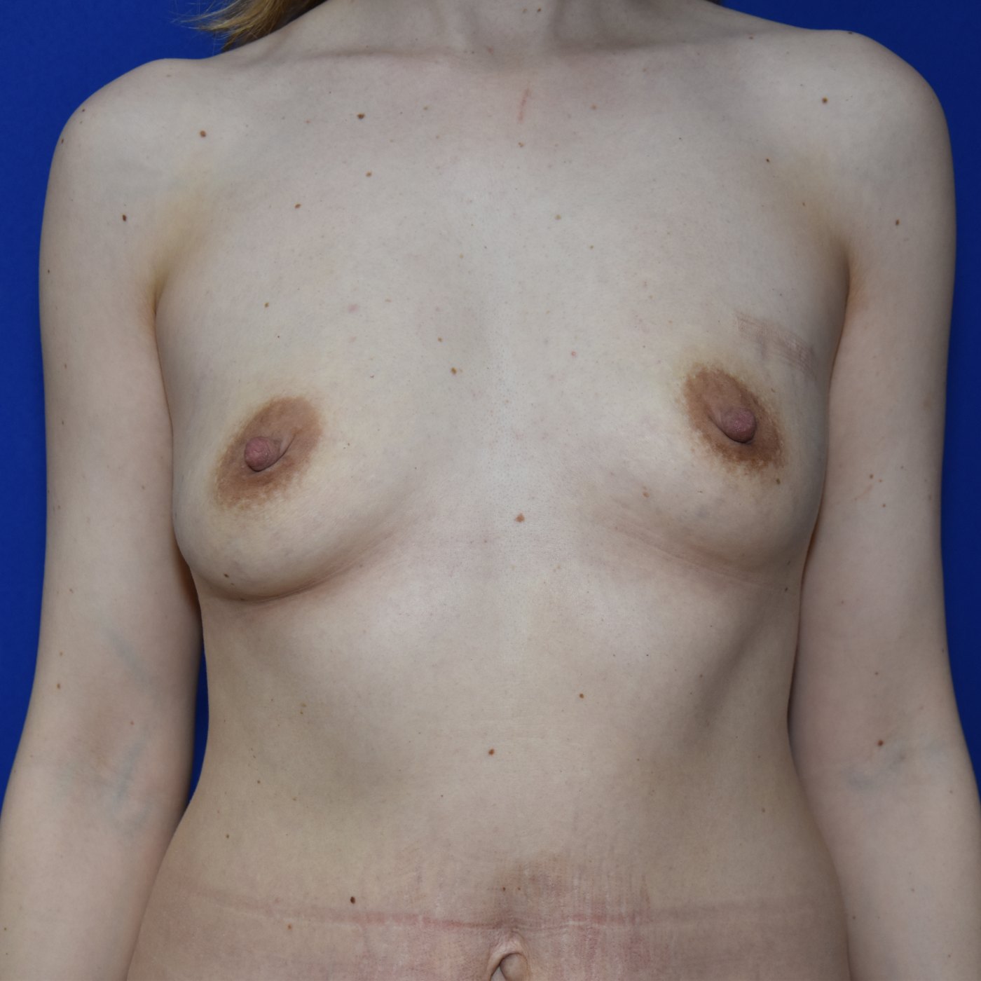 Bruststraffung mit Implantat Vorher (1)