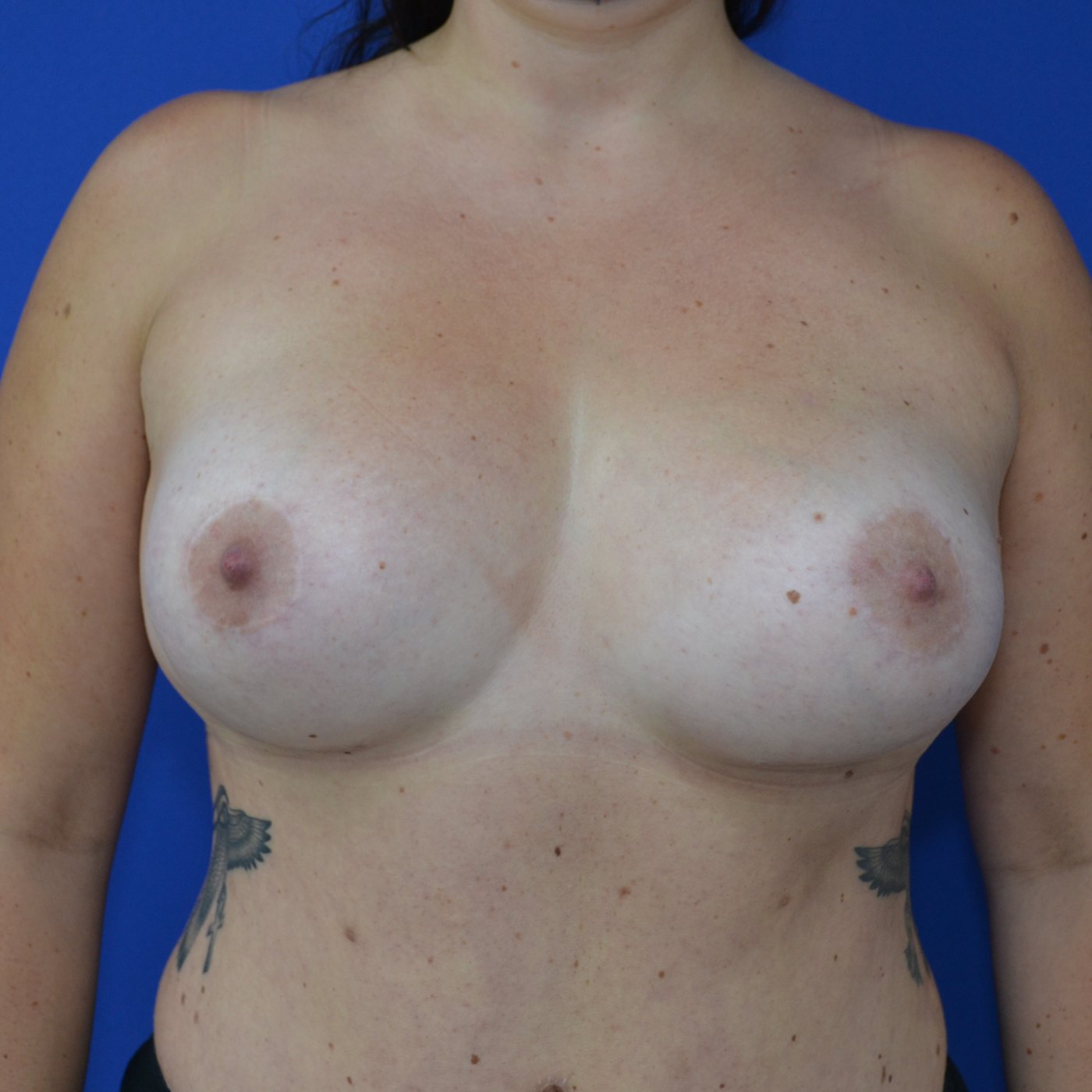 Bruststraffung mit Implantat Nachher (1)