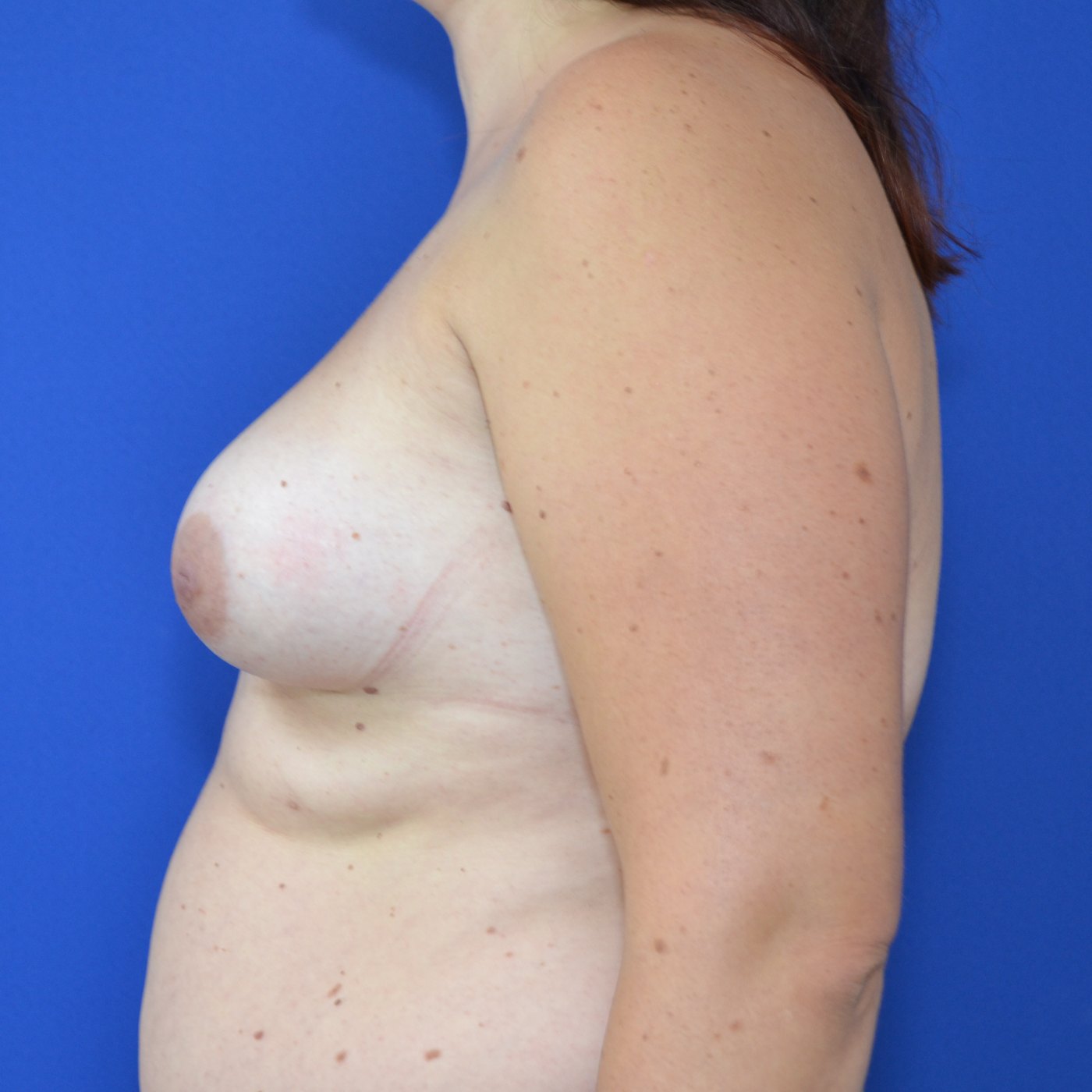 Bruststraffung mit Implantat Vorher (3)
