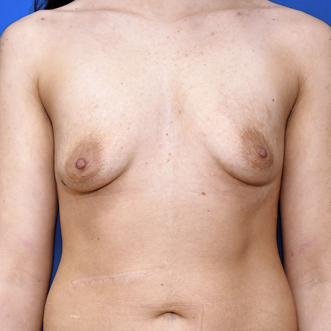 Bruststraffung mit Implantat Vorher (1)