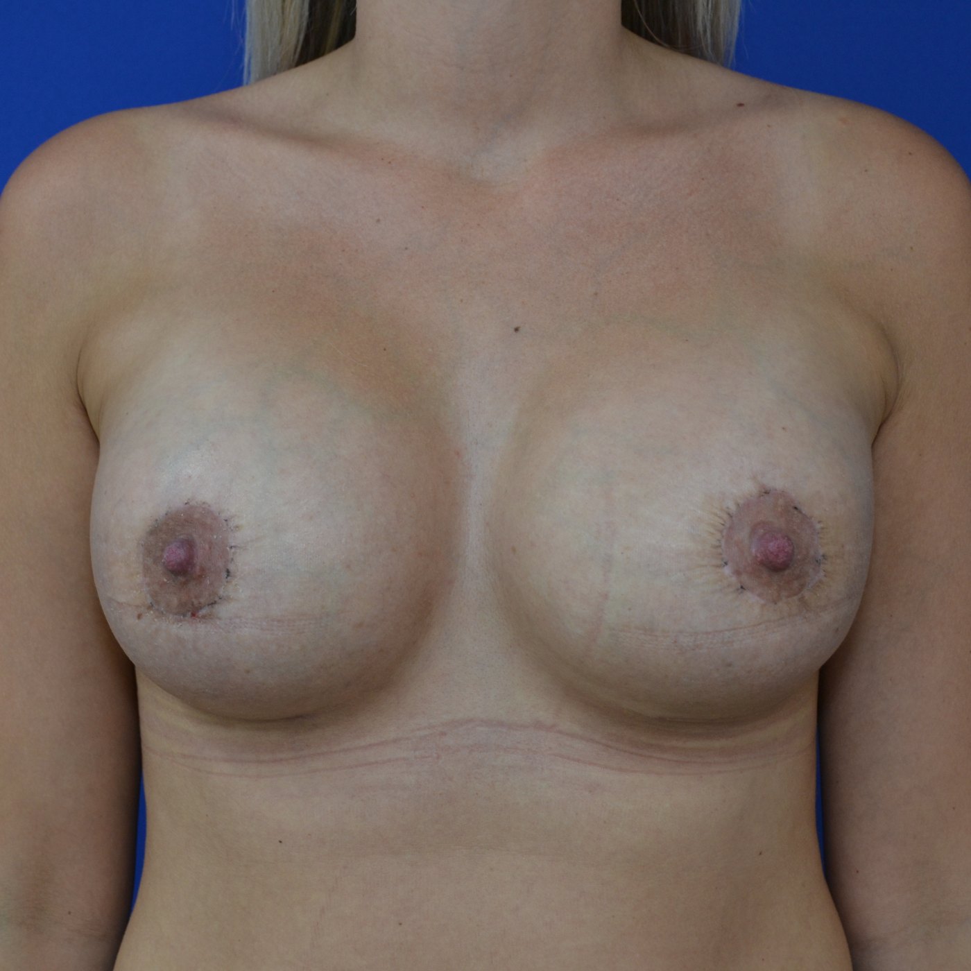 Bruststraffung mit Implantat Nachher (1)