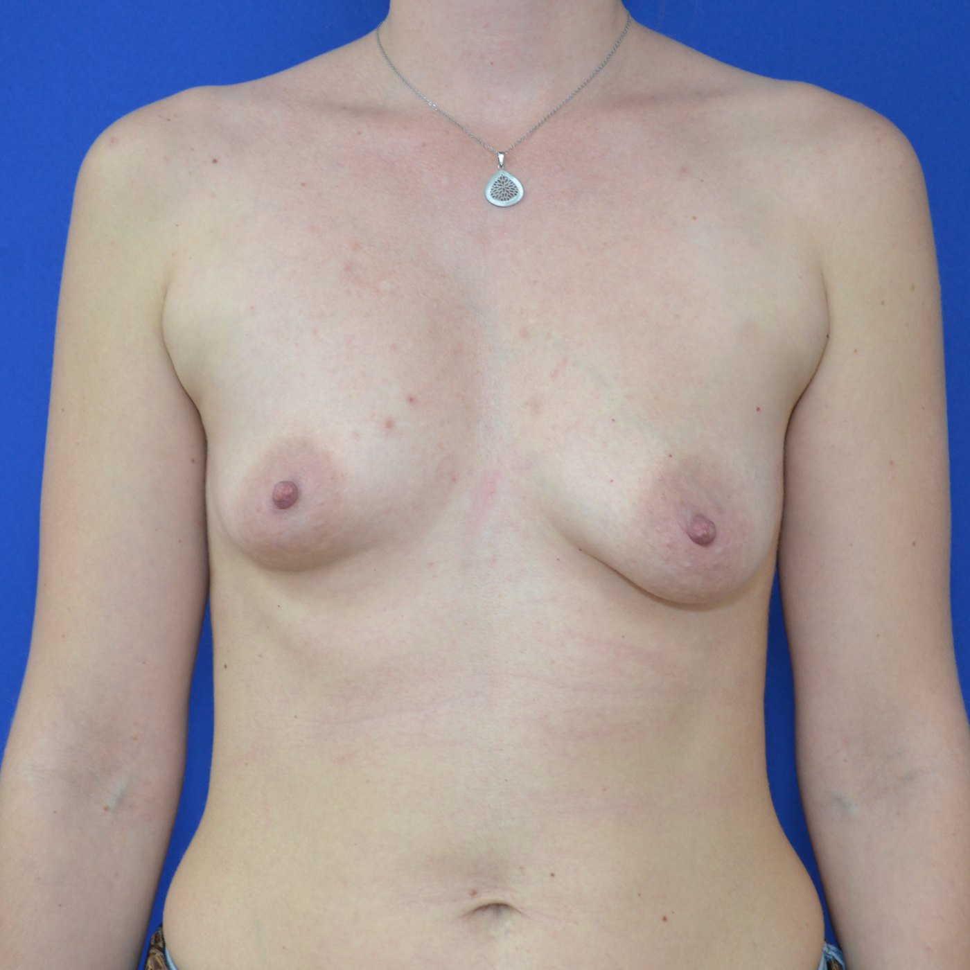 Bruststraffung mit Implantat Vorher (1)