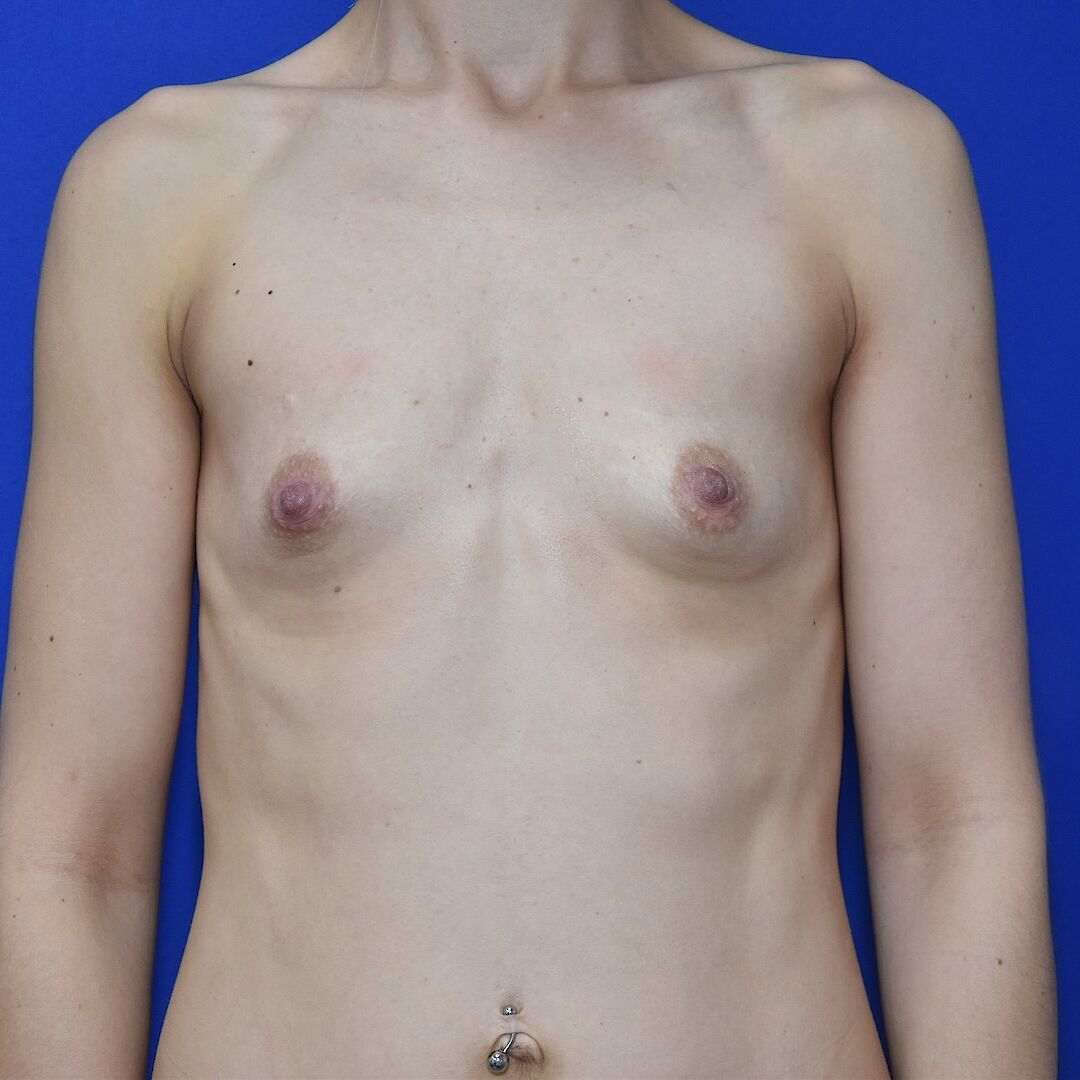 Brustvergrößerung Vorher (1)