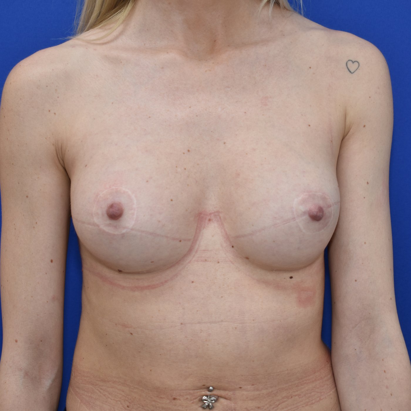 Bruststraffung mit Implantat Nachher (1)