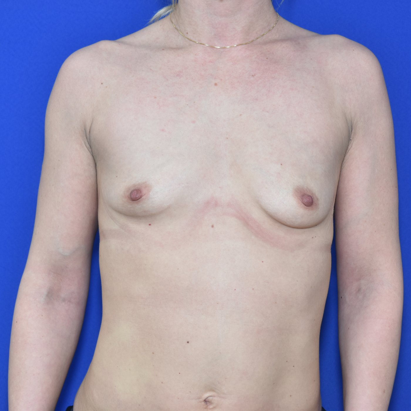 Bruststraffung mit Implantat Vorher (1)