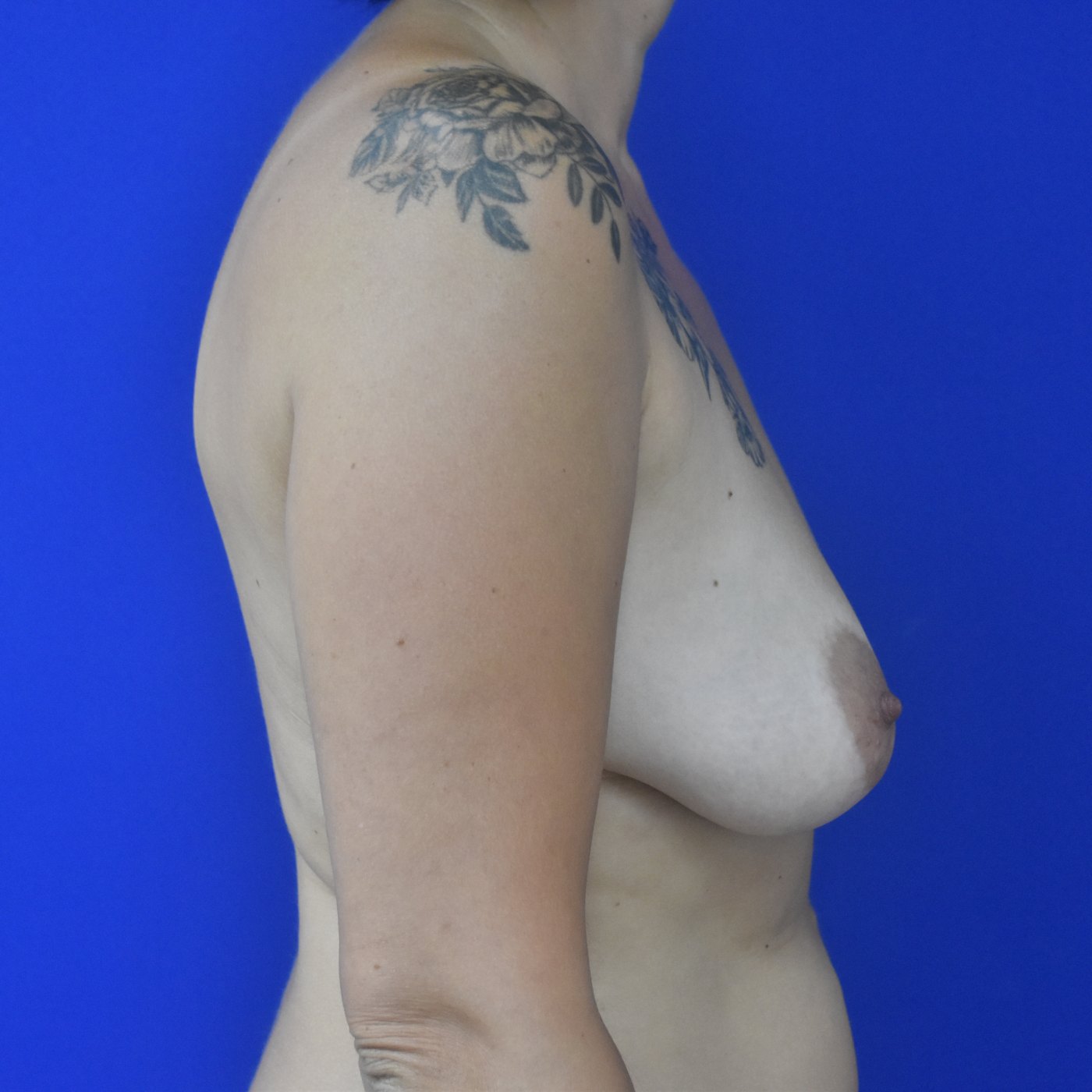 Bruststraffung mit Implantat Vorher (2)
