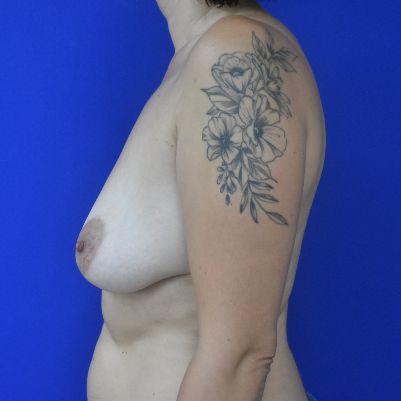 Bruststraffung mit Implantat Vorher (3)