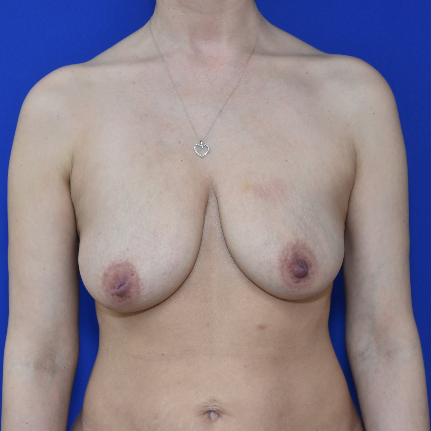Bruststraffung mit Implantat Vorher (1)