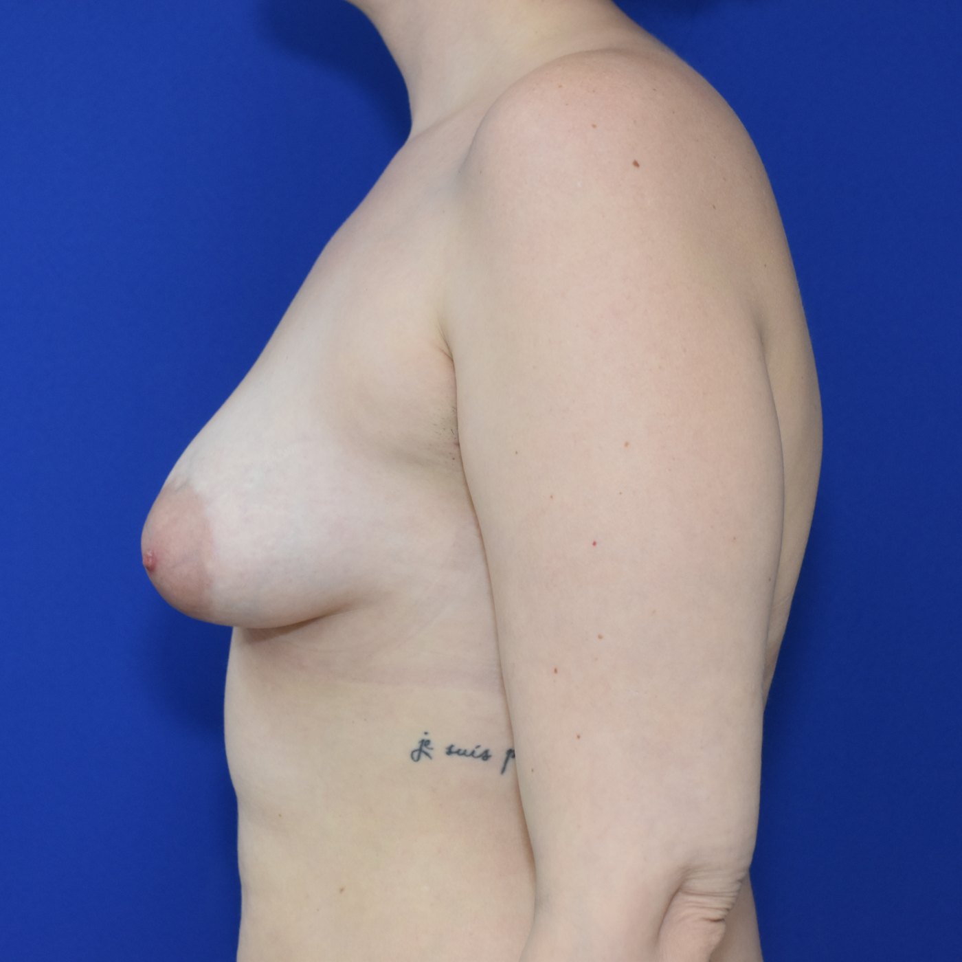 Bruststraffung mit Implantat Vorher (2)
