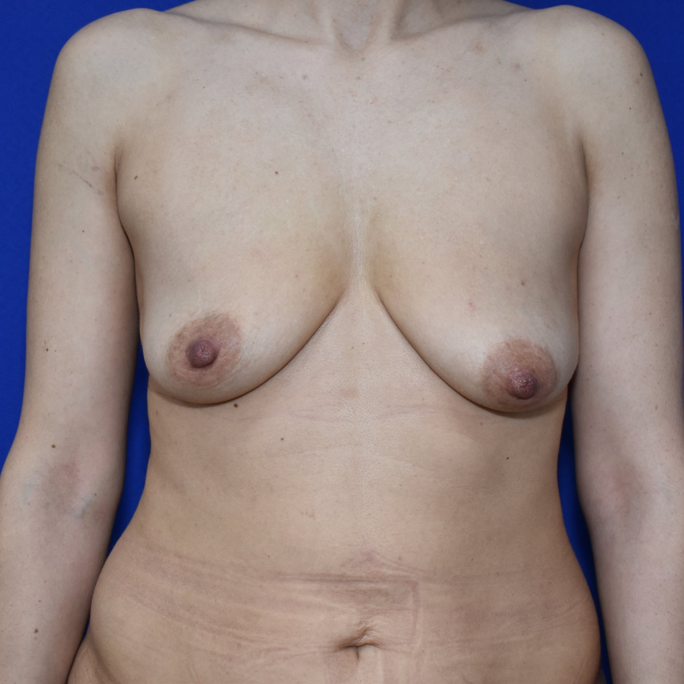 Bruststraffung mit Implantat Vorher (1)