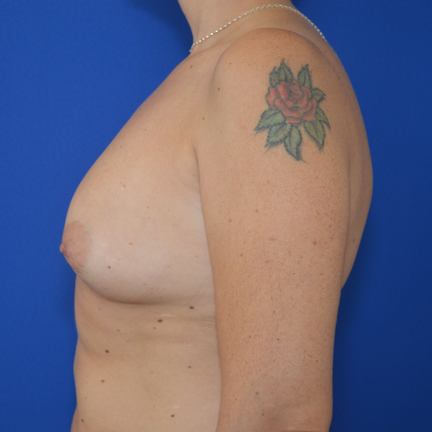 Bruststraffung mit Implantat Vorher (2)