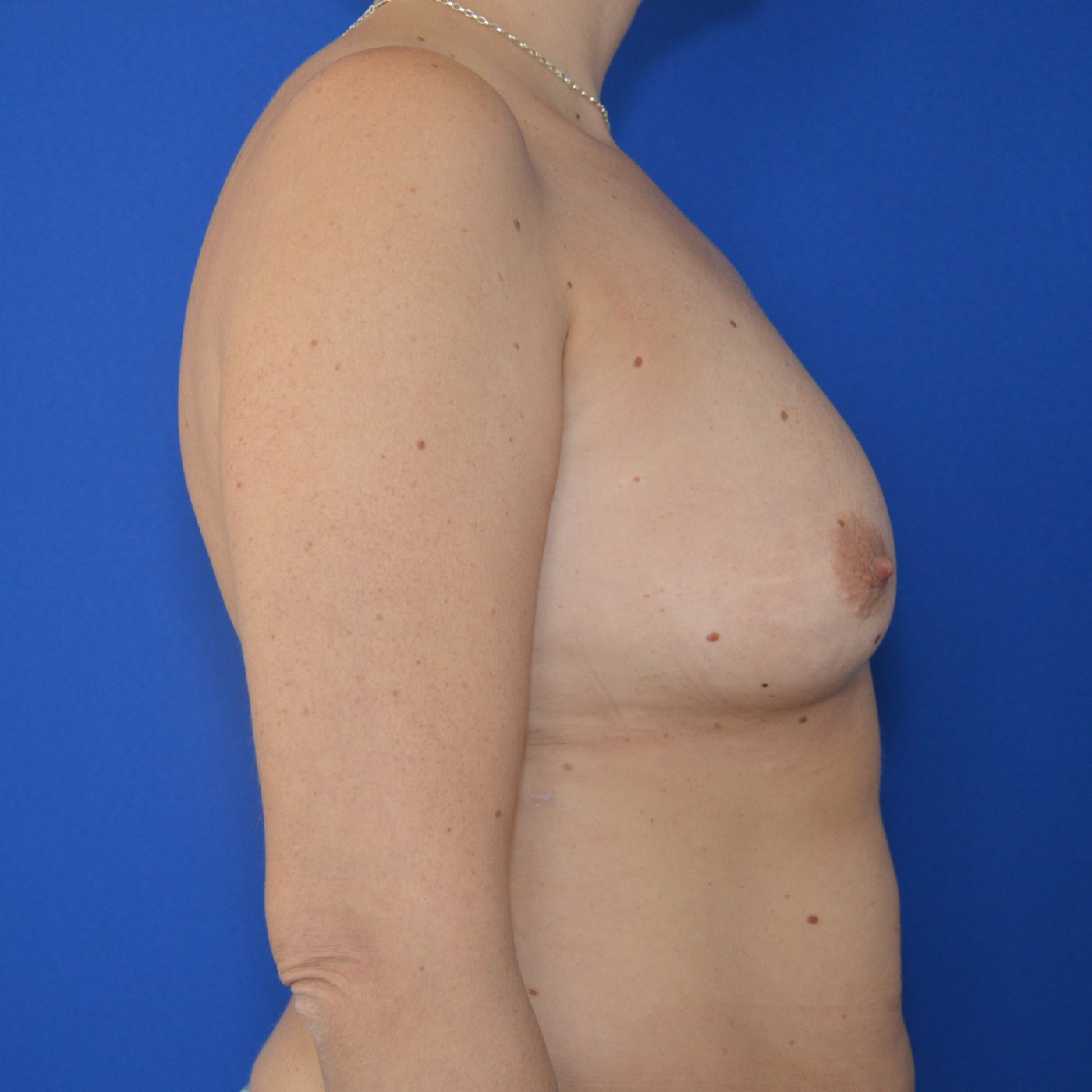 Bruststraffung mit Implantat Vorher (3)